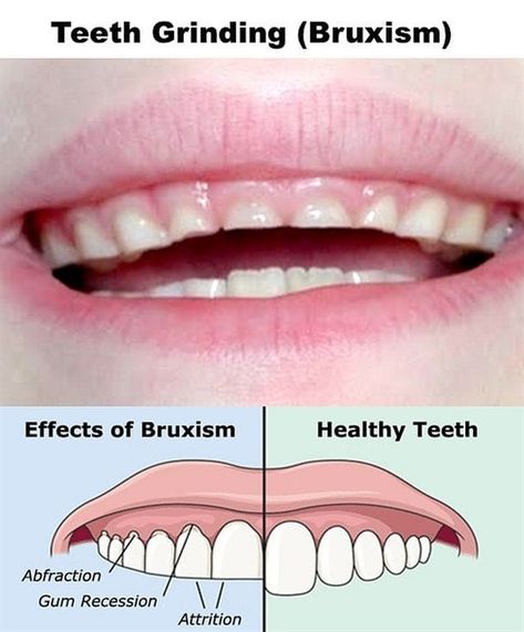 Dentaltown - Patient Education Ideas Dental Education, Dental Posts, Gum Recession, Teeth Grinding, Loose Tooth, Pediatric Dental, Tooth Pain, Grinding Teeth, Periodontal Disease