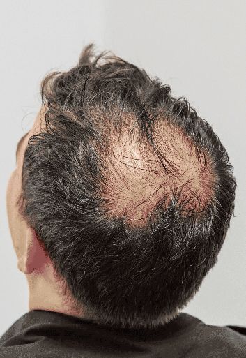 Evolved Hair Restoration Clinics is the best Hair Transplant Clinic in Perth Australia offering hair transplants for both men and women with undetectable and guaranteed results Hair Transplant Surgery, Best Hair Transplant, Male Pattern Baldness, Pattern Baldness, Bald Hair, New Hair Growth, Hair Replacement, Hair Transplant, Hair Restoration