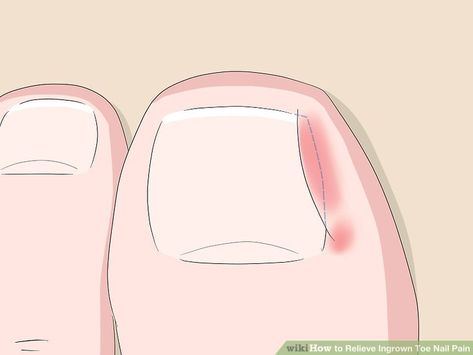 5 Ways to Relieve Ingrown Toe Nail Pain - wikiHow Toenail Pain, Toenail Removal, Ingrown Nail, Nail Bed, Ingrown Toe Nail, Toenail Fungus, Nail Fungus, Dental Floss, Platform Wedge