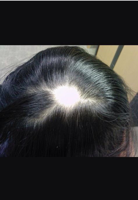 Alopecia- Non infectious Baldness Solutions, Keeping Hair Healthy, Regrow Hair Naturally, Bald Spot, Lost Hair, Roots Hair, Natural Hair Growth, Hair Hair, Hair