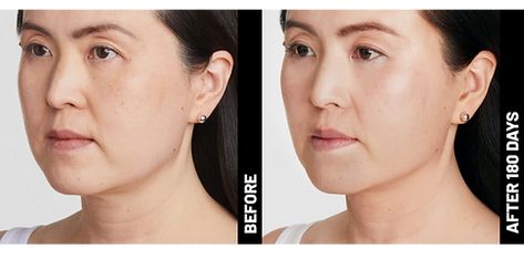 Ultherapy Before And After, Grow Eyebrows Faster, Brow Hacks, Castor Oil For Skin, How To Grow Eyebrows, Facial Wrinkles, Brow Lift, Deep Skin, Deep Wrinkles