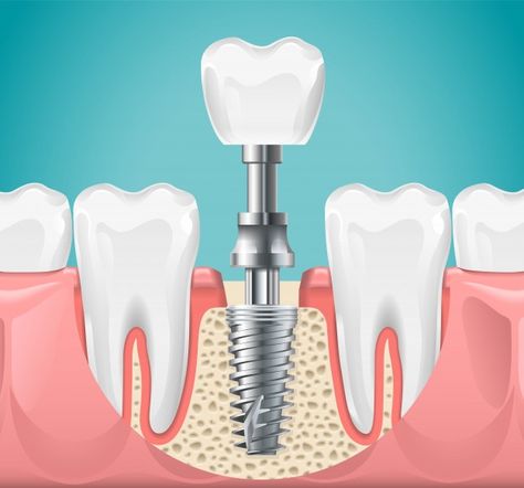 Free Dental Implants, Tooth Implant, Affordable Dental Implants, Dental Images, Dental Implant Procedure, Dental Posters, Best Dental Implants, Dental Implant Surgery, Bone Grafting