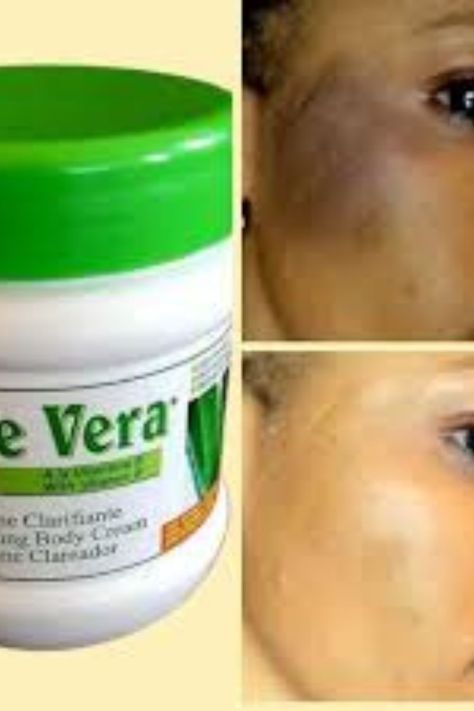 Aloe Vera Brightening Face Cream For Dark Spots & Sun Burn in Nairobi  Central - Skincare, Face Cream For Dark Spots, Sunburn Peeling, Aloe Vera Cream, Natural Face Care, Cream For Dark Spots, Sun Burn, Perfect Skin Care Routine, Fade Dark Spots, Bath And Body Care