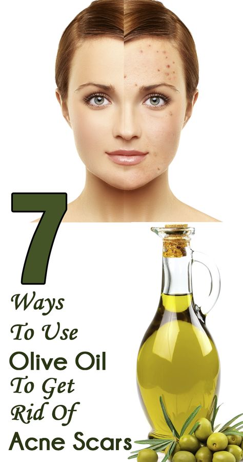 Acne is certainly one of the worst skin problems that we experience from time to time. Given here are 7 easy ways to use olive oil for acne scars. Read on to know more Get Rid Of Acne, Rid Of Acne, Beauty Remedies, Acne Remedies, Skin Remedies, How To Get Rid Of Acne, Skin Tips, Natural Products, Beauty Treatments