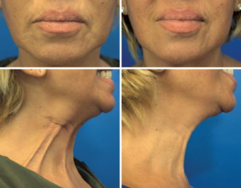 Discover the transformative power of the Nefertiti Lift. This comprehensive guide explores how this non-surgical procedure rejuvenates your neckline. - #nefertitilift Turkey Neck, Neck Lift, Muscle Weakness, Botox Injections, Laser Therapy, Age Defying, Reduce Wrinkles, Free Consultation, New Trends