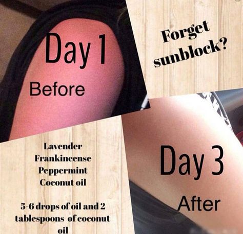 Sunburn Remedy, Essential Oil For Sunburn, Natural Wart Remedies, Natural Remedies For Sunburn, Sunburn Remedies, Sunburn Relief, Vetiver Essential Oil, Essential Oils For Headaches, Natural Acne Remedies