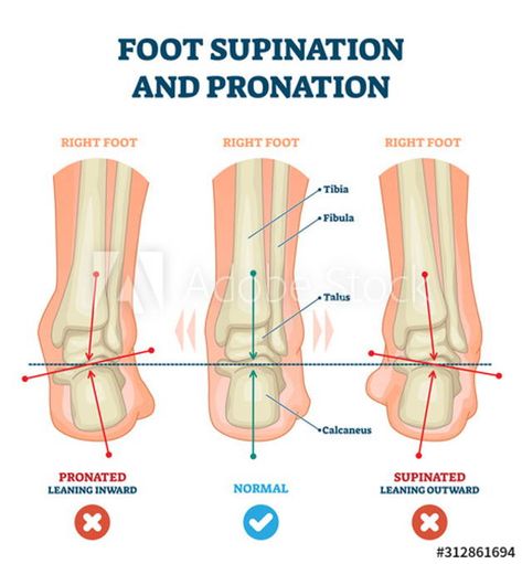 The Best Shoes for Supination– Viakix Pronation Exercises, Flat Feet Exercises, Knee Bones, Foot Exercises, Pelvic Tilt, Knee Exercises, Hip Pain, Calf Muscles, Heel Pain