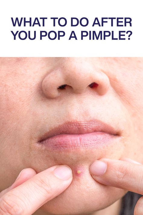 Wondering how to heal a popped pimple? Look no further, because here are some easy tips from board certified dermatologists to get rid of the acne and skin damage. How To Get Rid Of A Pimple Instantly, Pimple Patches Before And After, Acne Popping, Quickest Way To Get Rid Of Pimples, How To Heal A Popped Pimple, How To Heal Popped Pimples Fast, Instant Remedy For Pimples, Why Am I Getting Pimples, Neck Pimples