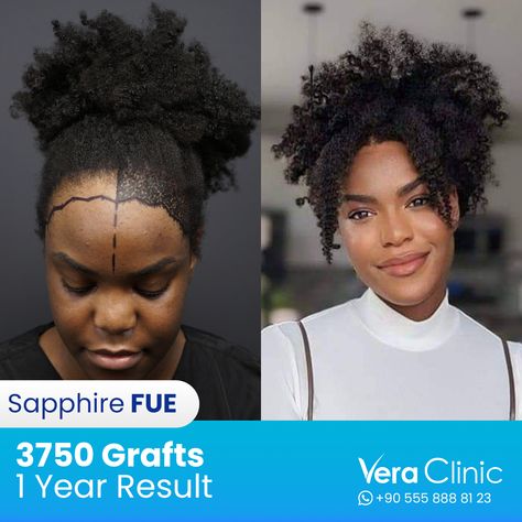 Our commitment is perfect for Hair Transplant Women Treatments as well. Swipe to see our progress at Afro Hair Transplant for women. 

Book your consultation today to get your hair perfectly done!
📲 | +90 555 888 81 23

#HairTransplant #HairRestoration #FUEHairTransplant #HairLossTreatment #TurkeyHairTransplant #VeraClinicResults #OxyCureTherapy #HairGraftSuccess #HairTransplantJourney #hairtransplantexperiences Hair Transplant Women, Fue Hair Transplant, Best Hair Transplant, Woman Hair, Afro Hair, Hair Restoration, Hair Transplant, Afro Hairstyles, For Hair