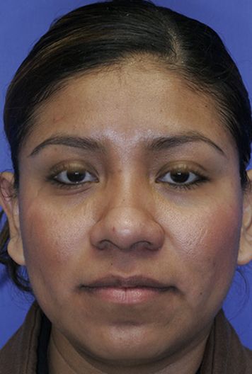 In this image, it shows this woman's wider nose and close set eyes.  If desired, and the nose is made to look more narrow, the eyes may need to be adjusted as though they are wide set eyes.  If we bring the nose in, we can bring the eyes in as well, by extending eyeliner out towards the nose, Nose Refrences Photos, Wide Nose Women, Extreme Plastic Surgery, Bulbous Nose, Nose Types, Wide Set Eyes, Learn Yoga Poses, Wide Nose, Cramps Relief