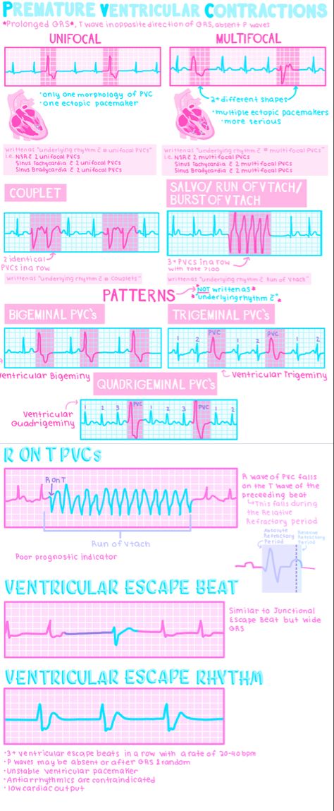 EKGs Ekg Cheat Sheet, Paramedic School Notes, Ekg Technician Aesthetic, Cardiac Pathology, Telemetry Technician, Medical Study Notes, Ultrasound Notes, Ekg Tech, Med Notes