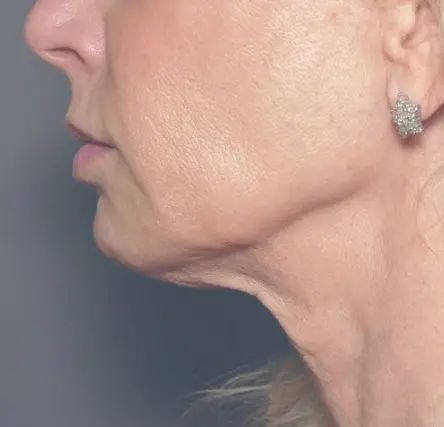 How To Tighten Sagging Jowls - Doctor Nyla Medispa Sagging Jowls, Facial Veins, Laser Skin Tightening, Nose Reshaping, Sagging Neck, Laser Skin Resurfacing, Oxygen Facial, Anti Wrinkle Treatments, Cosmetic Clinic