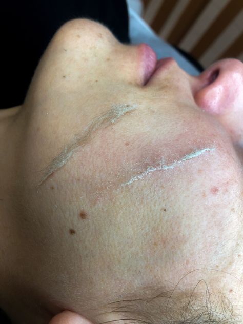 Facial dermaplaning Facial Dermaplaning, Dermaplaning Facial, Beauty Services, Funny Tweets, Beauty Nails, Profile Picture, Facial, Skin Care, Collage