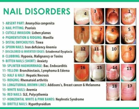 nail problems Vertical Nail Ridges, Fingernail Ridges, Nail Disorders, Nail Ridges, Nail Problems, Gray Nails, Heart Problems, Nail Fungus, Nail Health