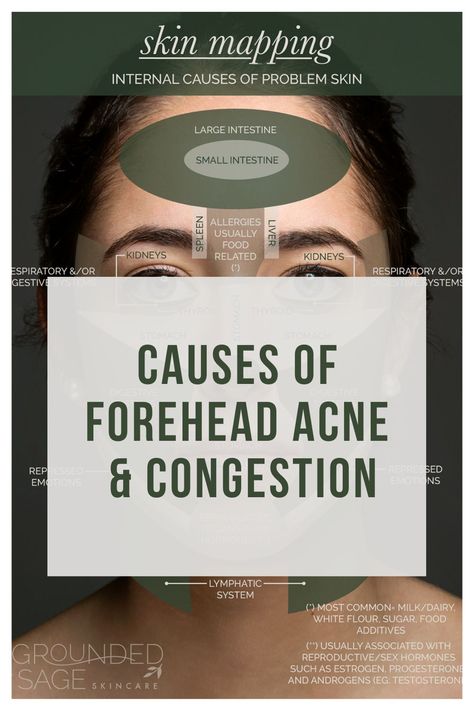 Bumps On Forehead, Forehead Acne Cause, Forehead Bumps, Skin Mapping, Pimples On Forehead, Face Mapping Acne, Forehead Acne, Acne Skincare Routine, Natural Acne Remedies