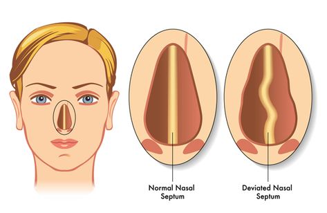 deviated septum Remedy For Sinus Congestion, Home Remedies For Sinus, Sinus Congestion Relief, Nasal Septum, Congestion Relief, Nasal Cavity, Sinus Congestion, Breathing Problems, Nose Shapes