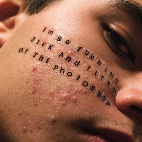 this photographer takes beautiful portraits of people with acne - i-D Acne, On Instagram, Instagram