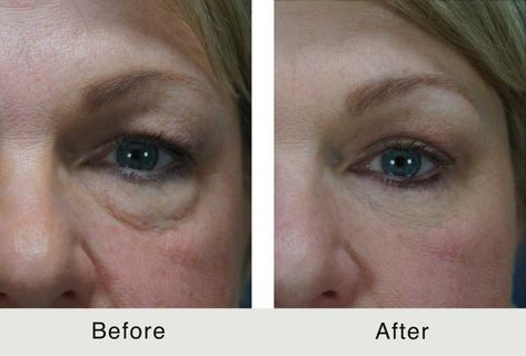 Hooded Eye Surgery, Eye Bag Surgery, Eye Lift Surgery, Lower Face Lift, Eye Bag Remedies, Skin Tightening Procedures, Laser Skin Tightening, Facial Procedure, Under Eye Fillers