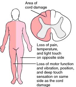 Brown-Sequard syndrome | definition of Brown-Sequard syndrome by Medical dictionary Spinal Cord Syndromes, Transverse Myelitis, Medical Dictionary, Nursing School Survival, Exam Review, Stem Cell Therapy, Cell Therapy, Medical Terms, Exam Prep