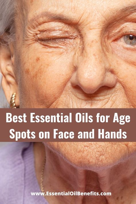 Essential Oils For Age Spots, Age Spots On Face, Home Remedies For Wrinkles, Brown Age Spots, Age Spot Removal, Essential Oils For Face, Lotion For Oily Skin, Dark Spots On Face, Brown Spots Removal