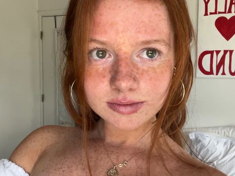 Freckles! Apple Cheeks, Beautiful Freckles, Freckle Face, In Summer