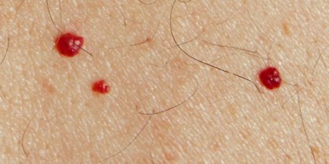 4 Strange Skin Changes You Might Notice After Age 40womansday Red Moles, Heat Rash, Skin Spots, Pregnant Diet, Migraine Headaches, Skin Diseases, Skin Issues, Good Healthy Recipes, Red Dots