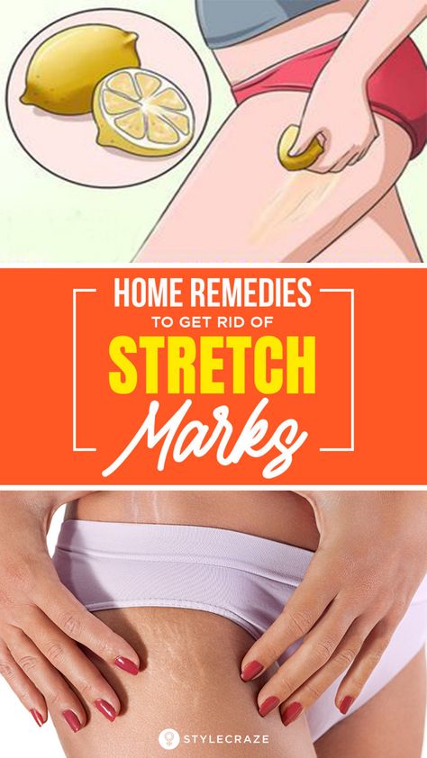 Get Rid Of Stretch Marks At Home Naturally: These ugly scars are usually seen on the abdomen, thighs, and upper arms. The causes include drastic and sudden weight loss or gain, a sudden change in the body size, hereditary factors, and stress. There are many ways to remove stretch marks and, usually, a combination of methods works the best. Within a few weeks, you will notice those unsightly lines lightening and becoming less visible. #StretchMarks #Remedies #HomeRemedies #SkinCare Strech Marks Remedies, Strech Marks, Stretch Mark Remedies, Stretch Mark Cream, Stretch Mark Removal, Home Remedy For Cough, Cold Sores Remedies, Sleep Remedies, Natural Sleep Remedies