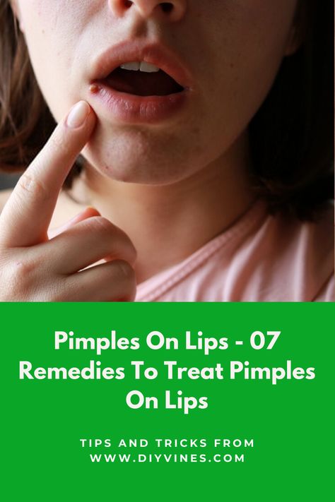 Pimples On Lips - 07 Remedies To Treat Pimples On Lips #pimples #pimplesonlips #lipspimples #acneonlips #lipsacne #beauty #beautytips #skincare #skincaretips #remedies #homeremedies #DIY #acne #acnescars #darkspots #skinspots Lip Pimple Remedies Overnight, Pimples Around Lips, How To Cover Pimples, Deep Pimple, Blackheads On Cheeks, Lip Pimple, Acne Remedy, Peroxide For Acne, To Remove Pimples