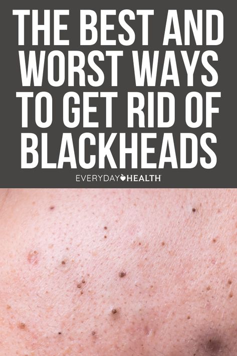 What Causes Blackheads? How to Prevent Blackheads on Your Skin The Best Ways to Get Rid of Blackheads The Worst Ways to Get Rid of Blackheads Acne comes in many shapes, sizes, and colors — and sometimes, the skin condition doesn’t look like an obvious blemish at all. Take blackheads, those pesky dark-colored gunk-filled spots. If you’ve ever tried squeezing one, you’ve probably found yourself facing down an angry bump instead and immediately regretted it. How To Get Rid Of Blackheads On Cheeks, How To Get Rid Of Blackheads, What Causes Blackheads, How To Prevent Blackheads, Blackheads On Cheeks, What Are Blackheads, Rid Of Blackheads, Types Of Acne, Sleep Remedies