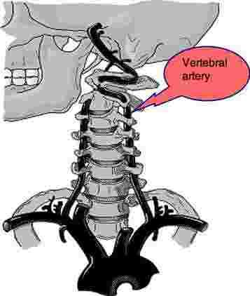 The vertebral artery wending its way around the atlanto occipital joint. Whiplash Injury, Vertebral Artery, Whiplash, The Skull, Chiropractic, The Head, A Horse, Headache, Natural Remedies