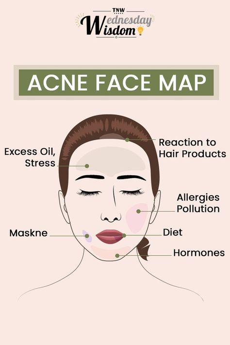 Reasons For Acne, Face Map, Acne Reasons, Face Mapping Acne, Face Mapping, Beauty Tips For Glowing Skin, Face Acne, Anti Acne, Skin Problems