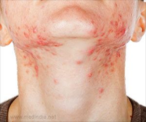 Home Remedies to Get Rid of Prickly Heat / Sweat Rash Heat Bumps Remedy, How To Get Rid Of Heat Bumps, Prickly Heat Rash Remedies, How To Get Rid Of Heat Rash, Heat Rash Remedy For Adults, Heat Rash On Face, Heat Bumps, Skin Rash Remedies, Heat Rash Remedy