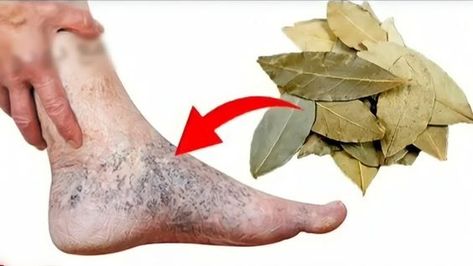 Vericous Veins, Varicose Vein Remedy, Bolesti Chrbta, Home Health Remedies, Skin Care Remedies, Good Health Tips, Healing Herbs, Natural Health Remedies, Health And Beauty Tips