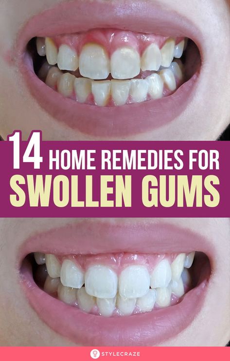 Swollen Gums Remedy, Grow Back Receding Gums, Fix Teeth, Tooth Infection, Remedies For Tooth Ache, Gum Inflammation, Swollen Gum, Teeth Health, Tooth Pain