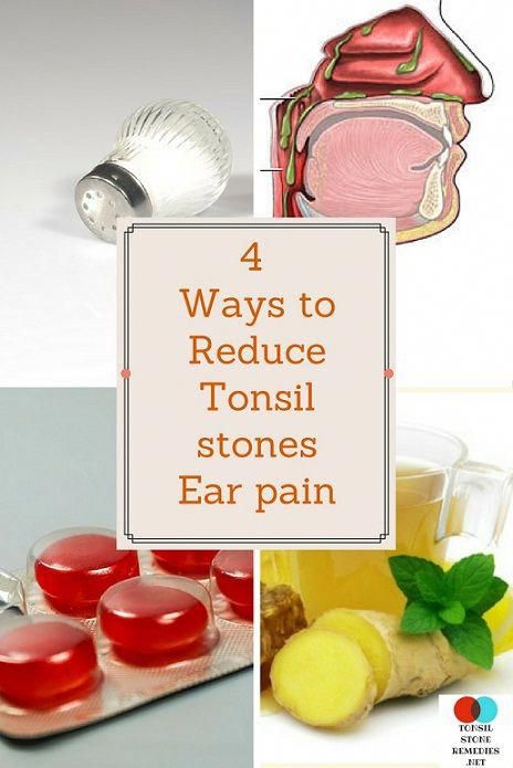 4 Ways to Reduce Tonsil stones ear pain Chronic Sore Throat, Swollen Tonsils, Earache Remedies, Clogged Ears, Ear Ache, Throat Infection, Keeping Healthy, Abdominal Pain, Natural Home Remedies