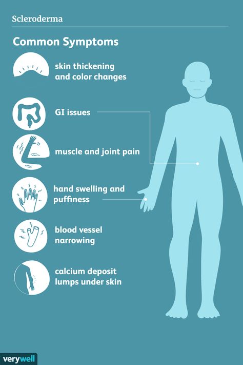 Scleroderma Symptoms, Swollen Hands, Scleroderma Awareness, Thyroid Healing, Sjogrens Syndrome, Digestive Issues, Skin Dryness, Chronic Inflammation, Skin Diseases