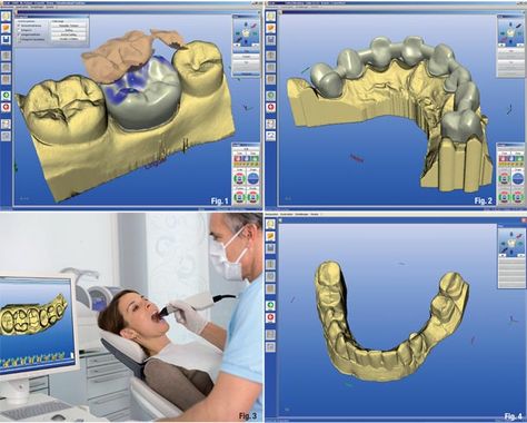 Cad/Cam dentistry... super cool.  brush your teeth so you don't need a crown... but if you do, look in to this Cad Cam Design, Dental Laser, Gum Surgery, Laser Dentistry, Laser Teeth Whitening, Dental Design, Dental Crowns, Cad Cam, A New World