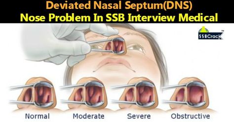 Deviated Nasal Septum(DNS) Nose Problem In SSB Interview Medical. Nasal Polyps, Sinus Remedies, Home Remedies For Sinus, Nasal Obstruction, Sinus Cavities, Nasal Septum, Congestion Relief, Allergy Remedies, Chest Congestion