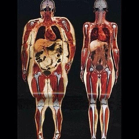 Body scan of a 220lb woman and a 112lb woman. If this isnt motivation to get up and eat healthy and workout, then i dont know what is! Iam NOT implaying that everyone needs to be 120 pounds, thats no where realastic for some people! #fitnesspageforall #Padgram Enlarged Heart, Body Scan, 120 Pounds, Body Scanning, Foto Tips, Motivation Fitness, The Human Body, Body Fat, Get In Shape