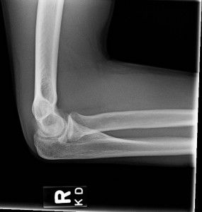 lat-elbow-xray Broken Elbow, Medical Things, Alphabet Book, Skin Care Acne, X Ray, Bones, Medical