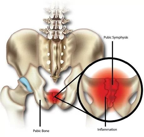 Osteitis pubis is a painful overuse injury that results in inflammation of the joint where the pubic bone meets the pelvis mainly due to kicking activities Pubic Symphysis Dysfunction, Pelvic Pain During Pregnancy, Back Pain Massage, Lower Back Pain Causes, Pelvic Bone, Muscle Rub, Trigger Point Therapy, Inflammation Causes, Psoas Muscle