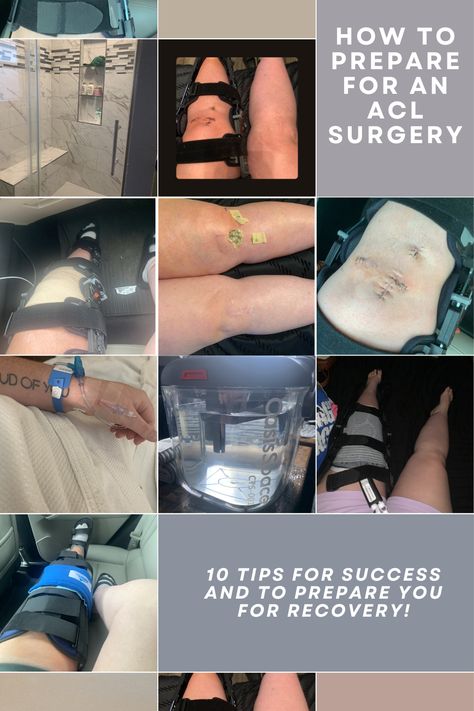 ACL Surgery is a tough mental and physical battle. Let me take you on my journey from my ACL Surgery in June 2024! Acl Recovery Timeline, Acl Aesthetic, Torn Ligament In Knee, Acl Surgery Recovery, Surgery Prep, Meniscus Surgery, Acl Knee, Acl Reconstruction Surgery, Knee Surgery Recovery