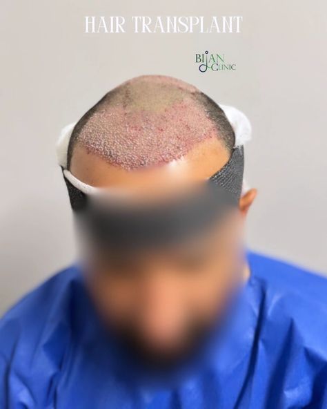 Get Your Hair Back at a Special Price! For a limited time only, take advantage of our exclusive hair transplant offer at Dr. Bijan's Clinic. Transform your look with expert care and at an unbeatable price. Don’t miss this chance to restore your confidence! **Book Now and Save!** 👇👇👇 Free video consultation --- #HairTransplant #SpecialOffer #DrBijanClinic #HairRestoration #ConfidenceBoost #LimitedTimeOffer #Aesthetic#HairLossSolution #SydneyHairClinic #sydneyhairtransplant #brisbine #goldc... Hair Clinic, Hair Back, Hair Restoration, Hair Transplant, Confidence Boost, Special Price, Limited Time, Confidence, Hair