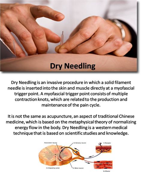 Dry Needling - @Emilie Claeys Claeys Peterson Dry Needling Therapy Physical Therapist, Acupuncture Migraine, Needling Therapy, Dry Needling Therapy, Thoracic Outlet, Sports Massage Therapy, Chronic Pain Management, Dry Needling, Sports Therapy