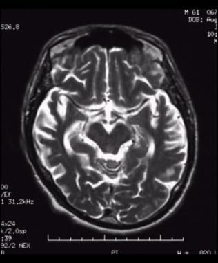 Brain Tumour Fake Report, Mri Brain, Cat Scan, Brain Scan, Mri Scan, Magnetic Resonance, Ct Scan, Report Template, Boyfriend Pictures