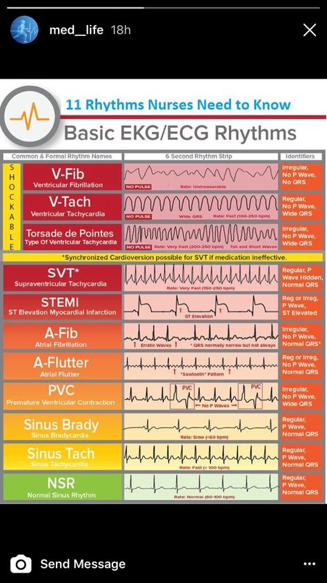 Different types of heart rhythms Room Basic, Paramedic School, Nursing Cheat, Nursing Mnemonics, Nursing Student Tips, Medical Student Study, Cardiac Nursing, Nursing School Survival, Critical Care Nursing