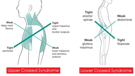 Correct your posture in 10 minutes with this routine Runner Stretching, Structural Adaptations, Upper Cross Syndrome, Lumbar Lordosis, The Agonist, Stretches For Runners, Pelvic Tilt, Muscle Imbalance, Bad Posture