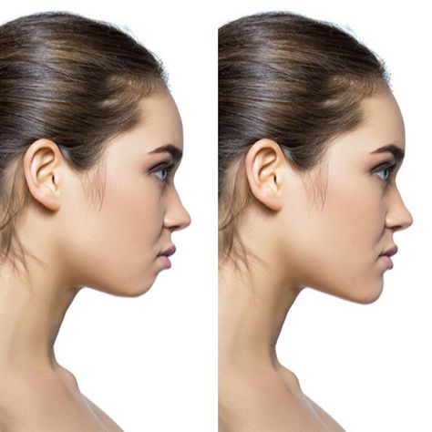 TRACEY H, RN BN on Instagram: “All about that chin.. 😉 *The only thing that’s altered in the photo is the model’s chin! See what a difference it can make?…” Face Ratio, Small Chin, Chin Surgery, Jaw Reduction Surgery, Clear Skin Overnight, Chin Filler, Plastic Surgery Fail, Rhinoplasty Nose Jobs, Botox Filler