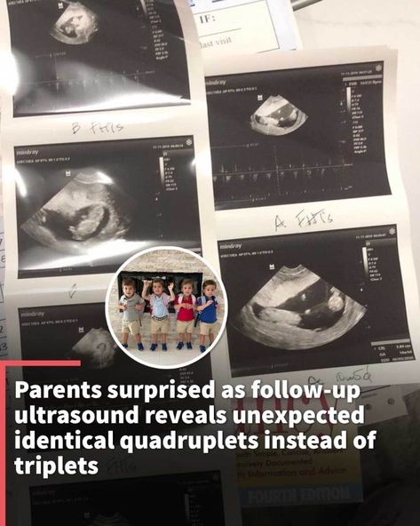 Ultrasound technician gives parents an odd look as he told them they're actually getting four babies instead of three. Read story here. Identical Quadruplets, Ultrasound Reveal, Ultrasound Technician, Sick Baby, Read Story, Unborn Baby, First Time Parents, Feel Good Stories, Third Baby