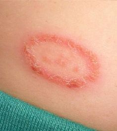 Skin conditions on Pinterest | Fungal Infection, Types Of and Html Skin Knowledge, Home Remedies For Sore Throat, Fungal Infection Skin, Yeast Infection Symptoms, Stomach Bug, Home Remedies For Skin, For Sore Throat, Crystal Makeup, Nail Problems